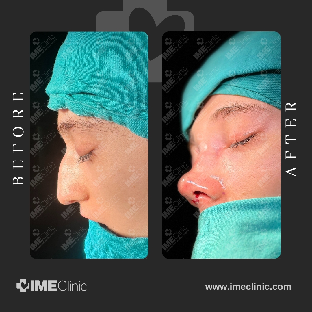 
                                     Side-by-side images showing a persons profile before and after a cosmetic nose procedure. The before image shows the original profile, while the after image shows the altered nose shape. Both images have a medical setting background.